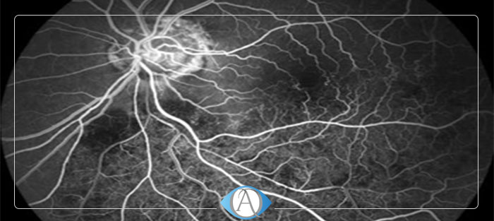 آنژیوگرافی چشم چگونه به تشخیص بیماری های چشمی کمک می کند؟