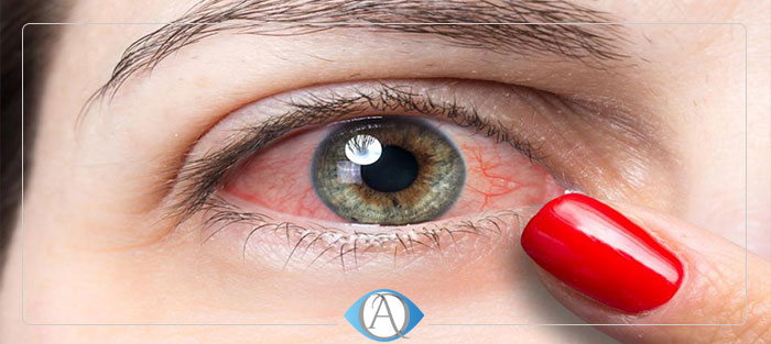  قرمزی چشم به علت بیماری کرونا