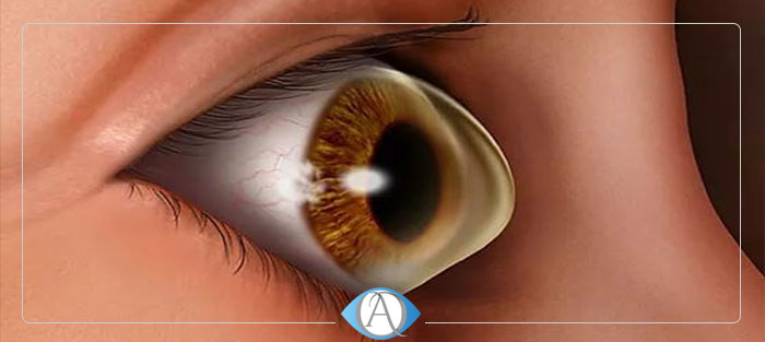 درمان قوز قرنیه با لنز تماسی