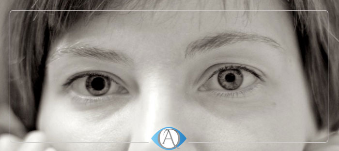 بیماری آنیزوکوریا چشم و علت اصلی بزرگی و گشادی مردمک چشم چیست؟