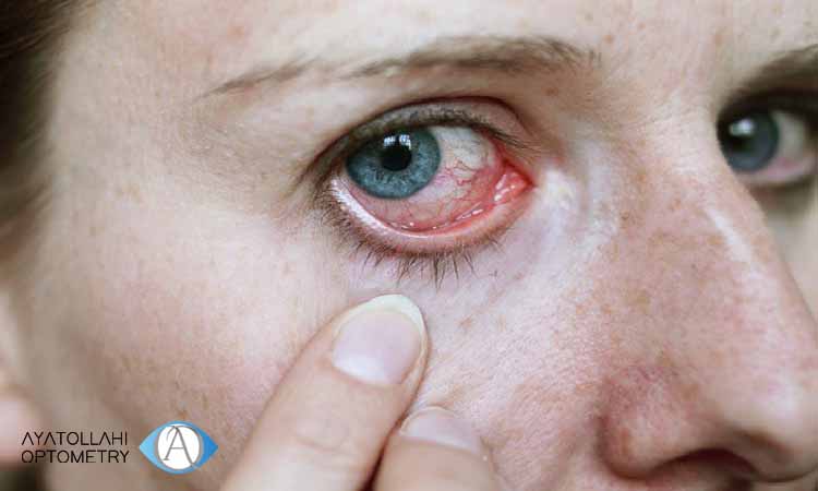 پیشگیری از بیماری تراخم چشم