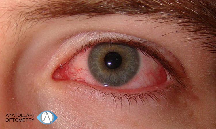 بررسی علائم خشکی چشم