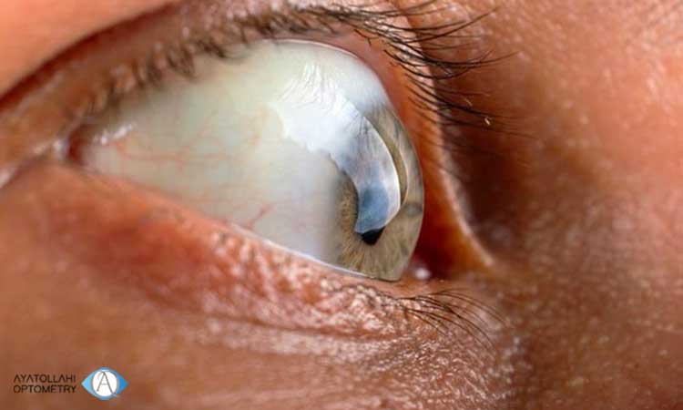 بیماری ضخیم شدن قرنیه چشم چیست؟