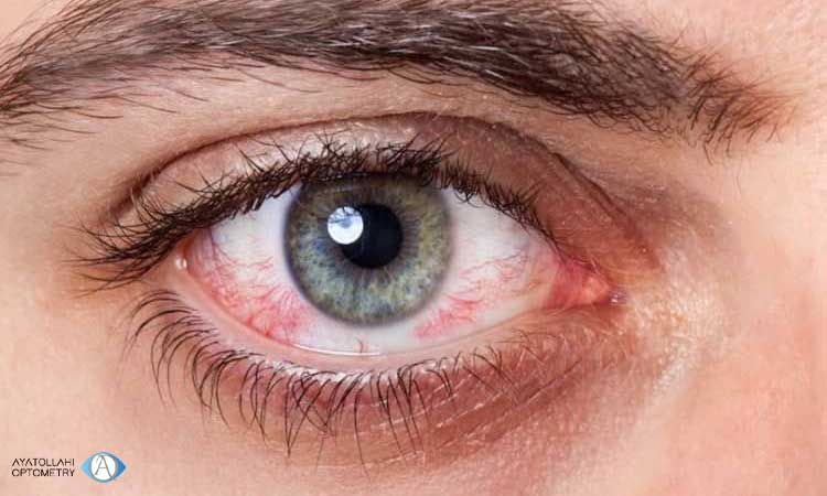 راه درمان ضعیف شدن عصب چشم
