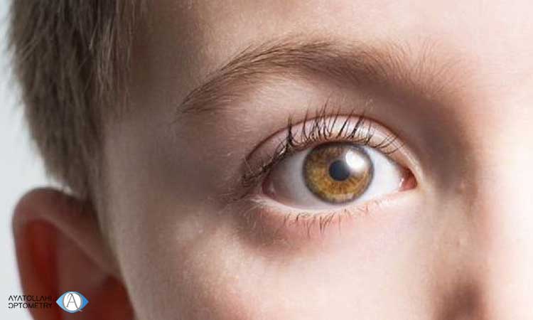 مشکلات ناشی از خشکی چشم