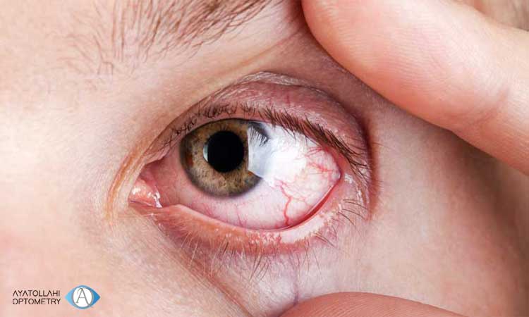 آیا خشکی چشم خطرناک است؟