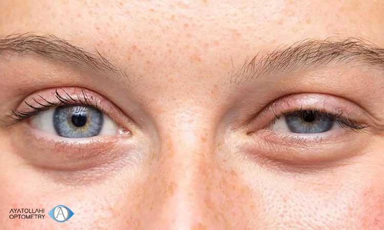درمان تورم ناگهانی پلک بالای چشم