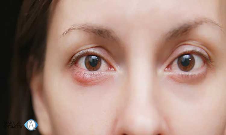 درمان کیست چشم چقدر طول می کشد؟