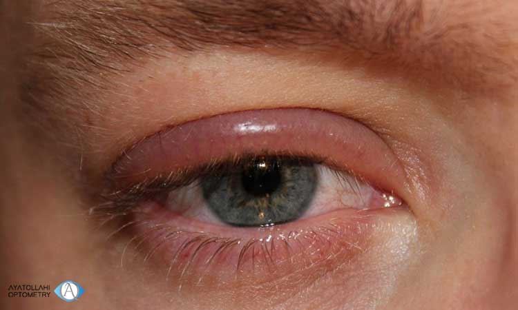  درمان تورم ناگهانی پلک بالای چشم