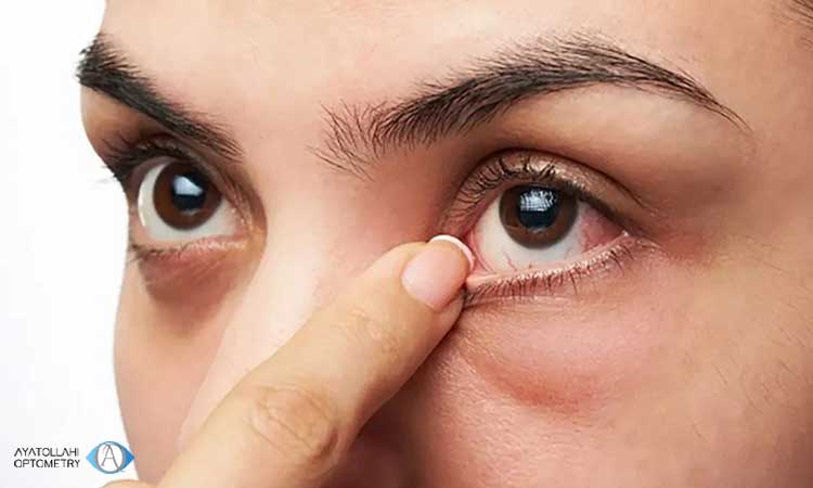 بررسی روش های درمان قطعی خشکی چشم