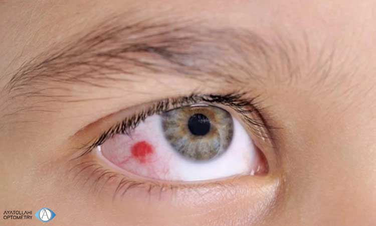بررسی خونریزی زیر ملتحمه چشم ناشی از ضربه به چشم