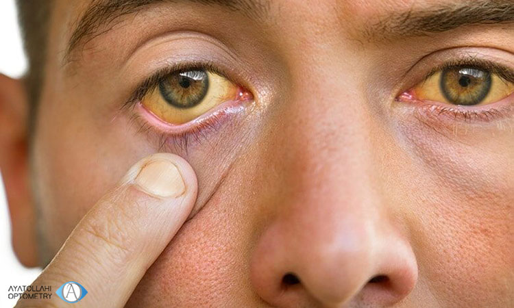  علت زرد شدن سفیدی چشم در بزرگسالان