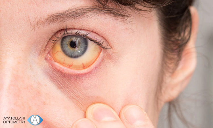 عوارض احتمالی زردی چشم 