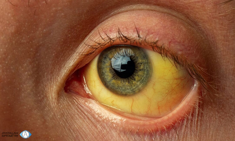 بررسی نشانه ها و علائم زردی چشم در بزرگسالان