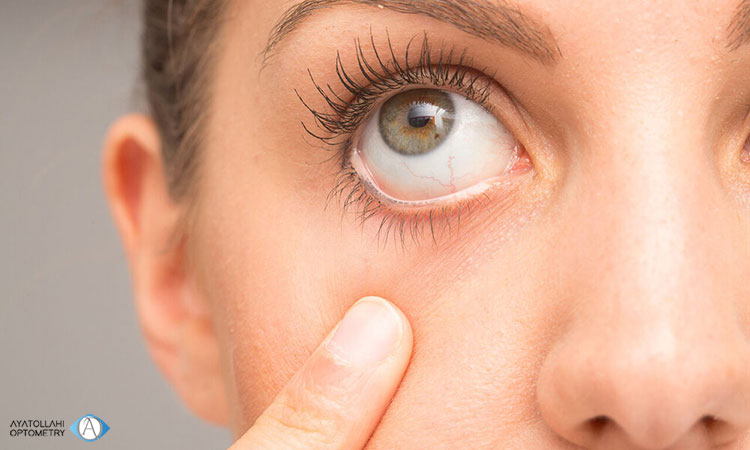  عوارض درمان نکردن خشکی چشم