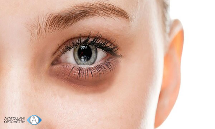 بررسی روش های درمان خشکی چشم