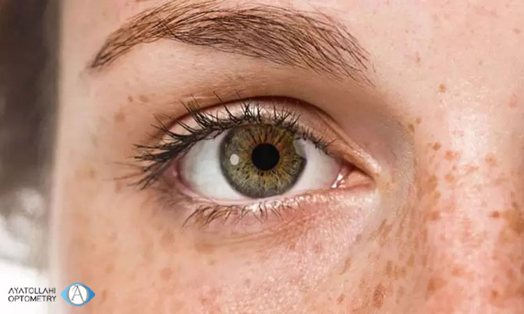 بررسی افراد مبتلا به خشکی چشم