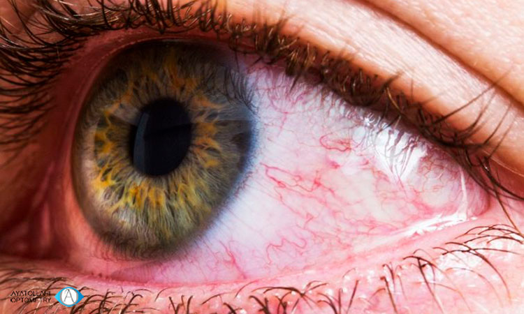 چگونگی درمان قرمزی چشم