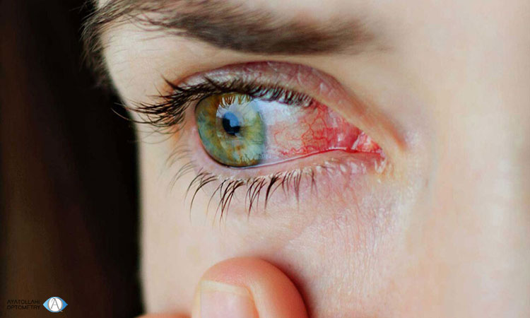  علائم خشک شدن چشم بعد از جراحی
