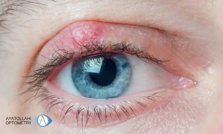 شالازیون چیست و چگونه ایجاد می شود؟