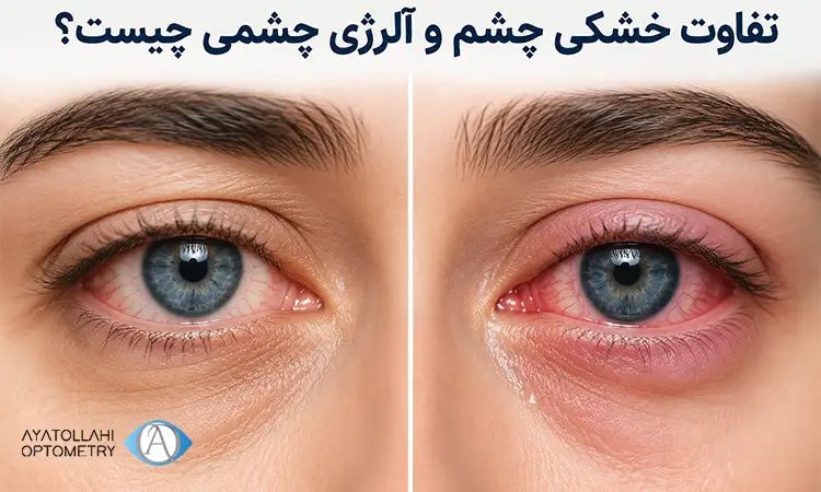 تفاوت خشکی چشم و آلرژی چشمی چیست؟