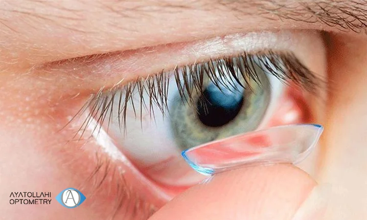 بررسی  لنز اسکلرال برای اصلاح نامنظمی قرنیه 